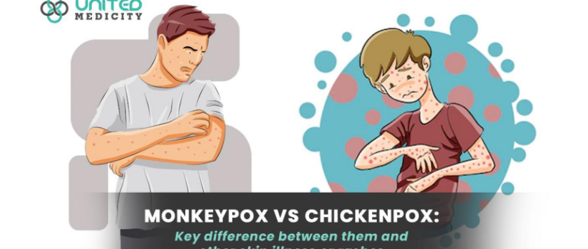 Moneypox vs chickenpox